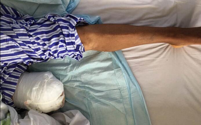 【保山安利醫(yī)院】濫用民間草藥，造成截肢后果