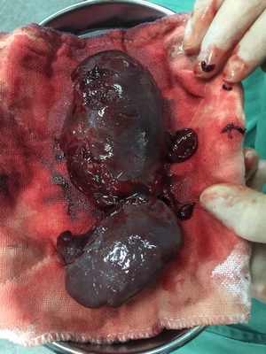 14歲男孩玩耍摔倒，脾臟破裂，險些喪命！