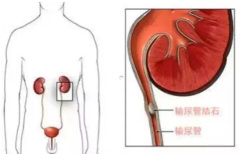 輸尿管結(jié)石，到底能不能保守治療？