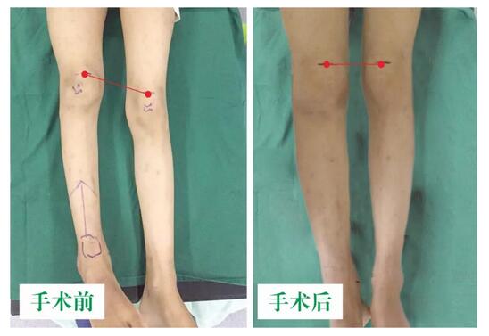 女孩墜梯右腿縮短5cm，幸得醫(yī)生及時診治恢復(fù)正常腿型