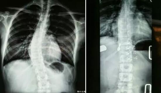 好好的脊柱怎么說彎就彎了？你竟然都沒發(fā)現(xiàn)……