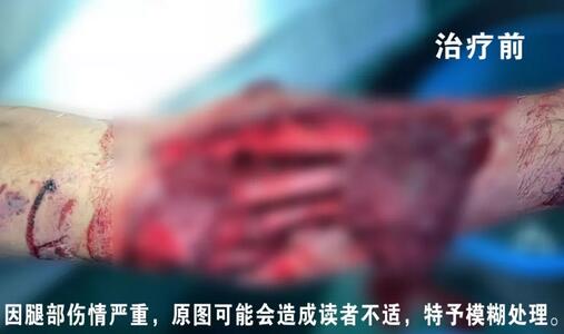 感謝安利醫(yī)院挽救了我的腿，沒有讓我落下殘疾……”