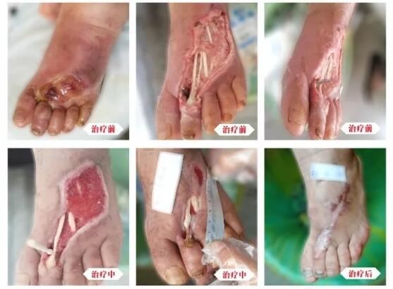糖尿病并發(fā)癥有多可怕，及時治療糖尿病足避免截肢！