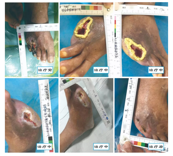 介入治療糖尿病足，您聽說過沒？