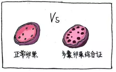 多囊卵巢綜合征與生酮飲食，您不知道的“減肥效果”