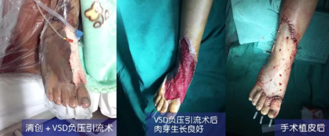 車禍猛如虎，救治如“華佗” ，手術(shù)＋康復，8歲小女孩車禍后日漸康復行走