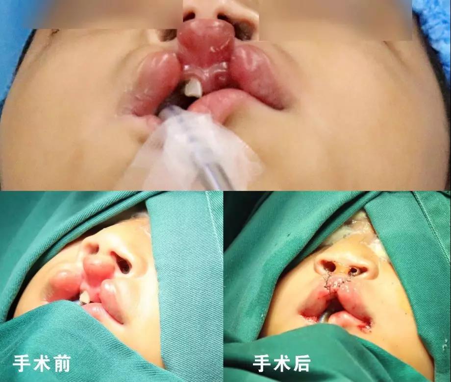 唇腭裂盡早治療消除孩子自卑心理，快樂成長！