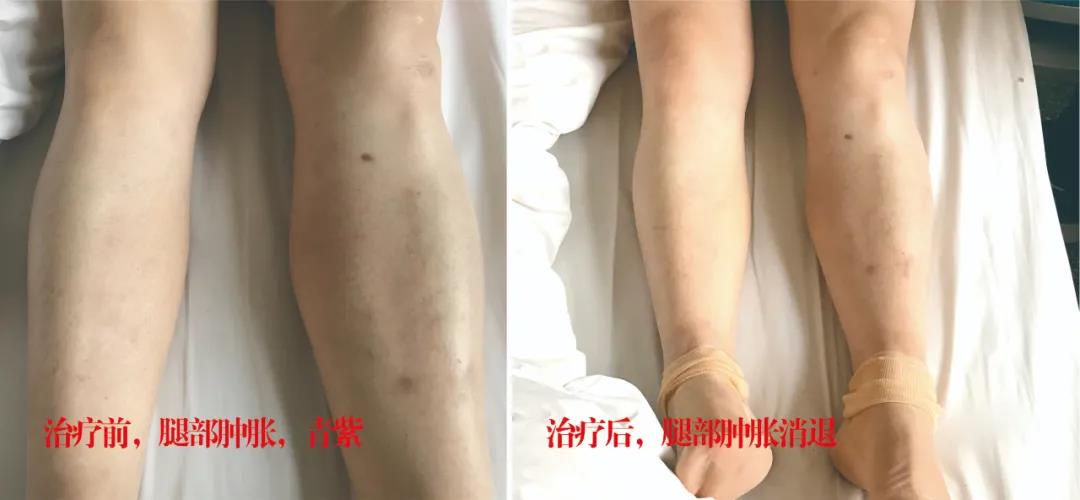 下肢靜脈血栓多年頑疾反復(fù)腫痛——疾病不容等待，早治療，早健康！