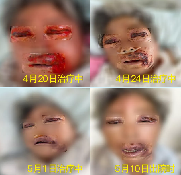 膿毒血癥（急性頜面部蜂窩組織炎）多學(xué)科聯(lián)合會診，幫助患者成功治愈！