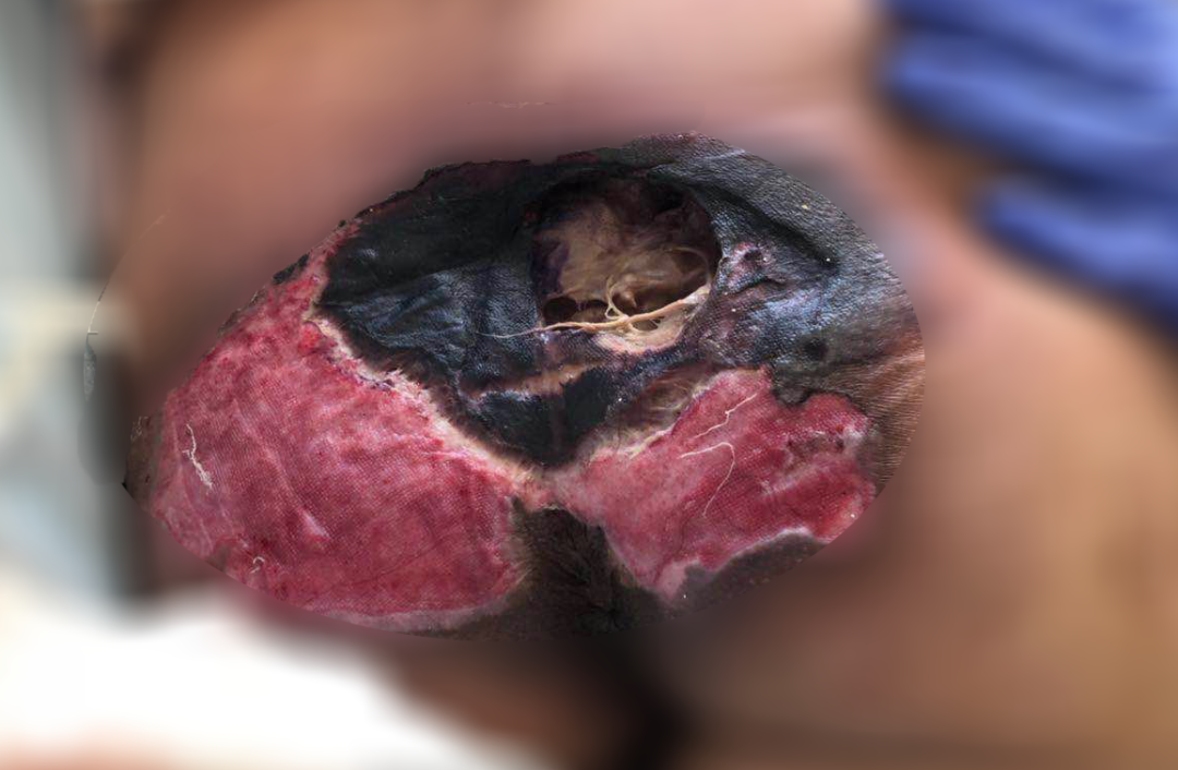 癱瘓3年的女患者臀部居然變成這樣?！