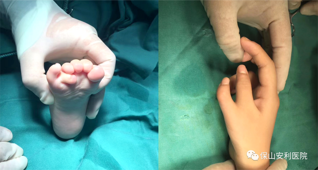 孩子先天手足多指（趾）不要慌，外二科幫你解除困擾！