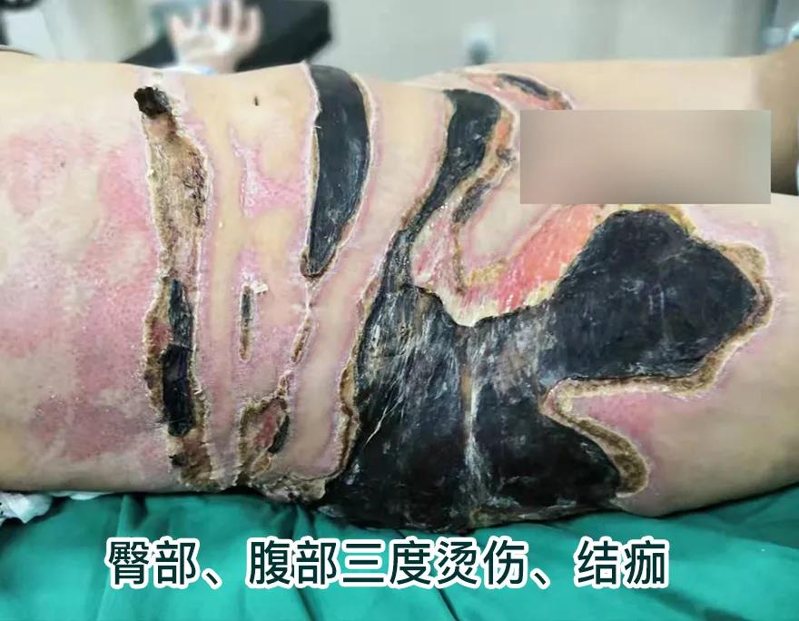 【保山安利醫(yī)院】80歲老人不慎燒傷，導(dǎo)致腹部、右側(cè)臀部大面積創(chuàng)傷，經(jīng)植皮治療創(chuàng)面逐漸愈合