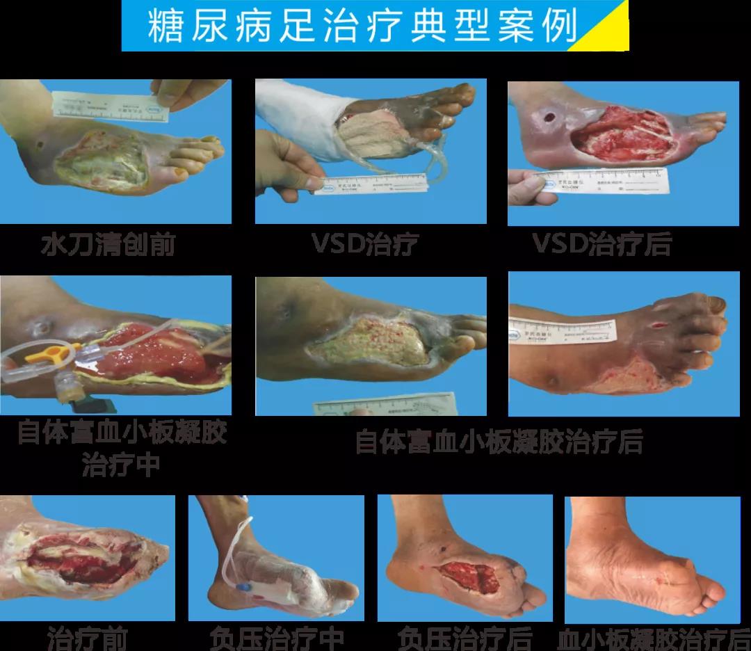 截肢、失明，甚至……，我們要做的是將糖尿病并發(fā)癥遏制在搖籃里！