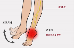 【保山安利醫(yī)院—健康科普】什么是足下垂！你了解嗎？