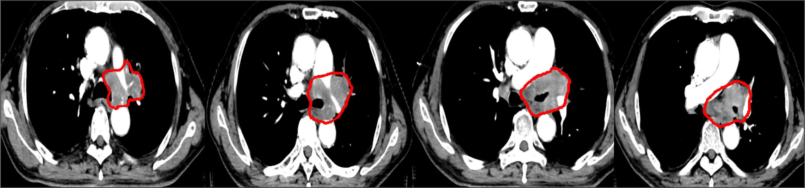 【保山安利醫(yī)院】對于局部晚期非小細(xì)胞肺癌患者，手術(shù)不能做，化療打不動，該怎么辦？