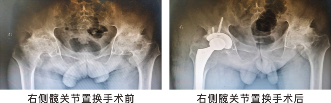 【保山安利醫(yī)院】長期飲酒導(dǎo)致雙側(cè)股骨頭壞死，髖關(guān)節(jié)置換后重獲運(yùn)動(dòng)功能！