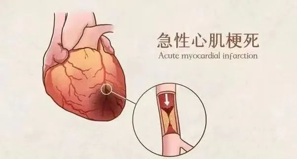 【保山安利醫(yī)院】11月20日“心梗救治日” 時間就是心肌，時間就是生命！