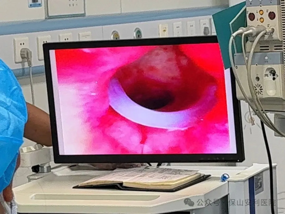 硬質(zhì)支氣管鏡下硅酮支架置入術(shù)-為氣道塌陷患者撐開(kāi)生命通道