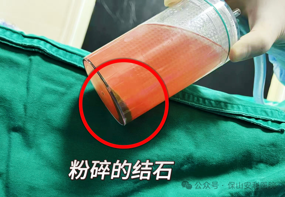 科普丨泌尿結(jié)石“克星”鈥激光碎石術(shù)，手術(shù)動圖揭秘全過程！